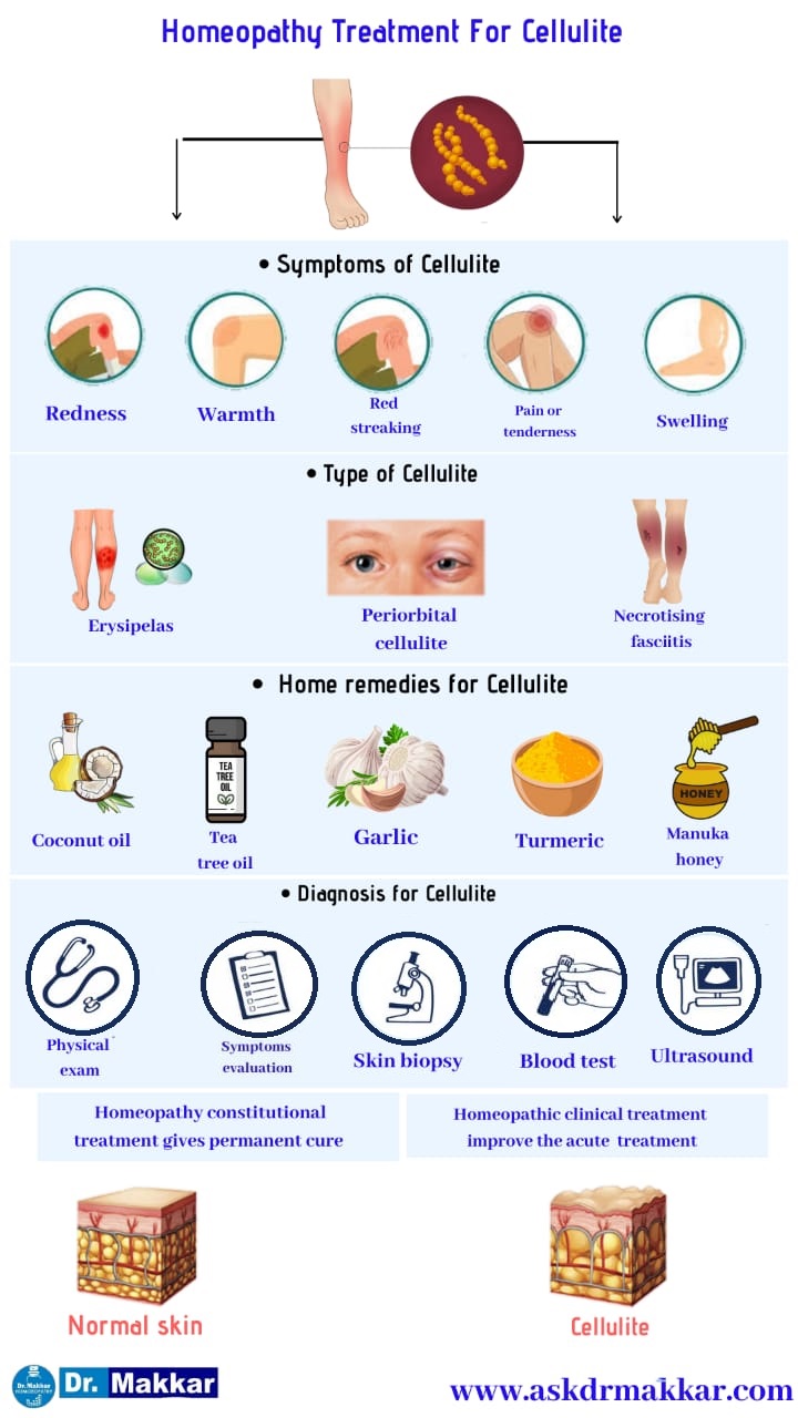 Cellulitis home deals treatment